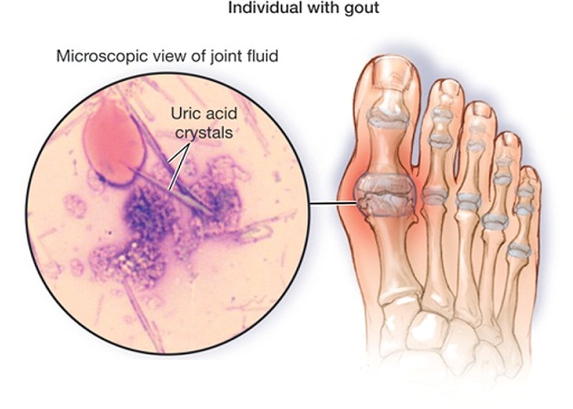polyarticular gout