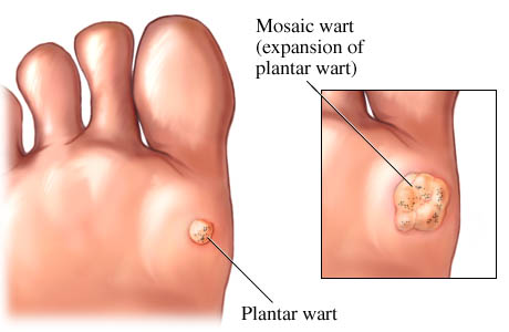 Define Warts