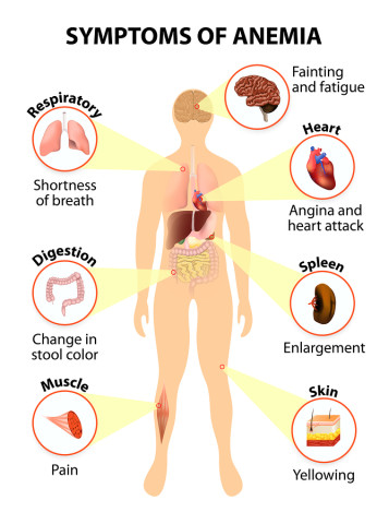 Anemia Homeopathic Treatment