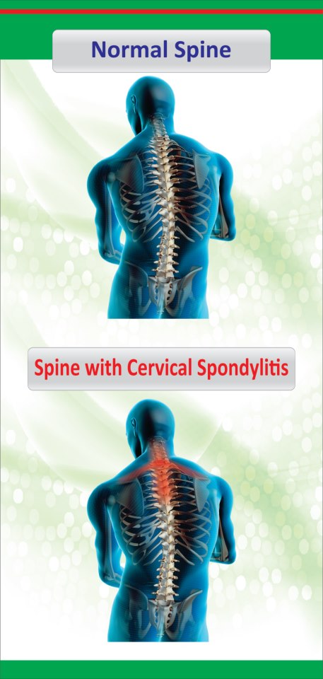 Cervical spondylosis neck pain Homeopathic treatment