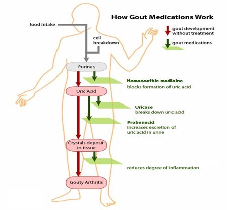 Homeopathic treatment  of gout explainer