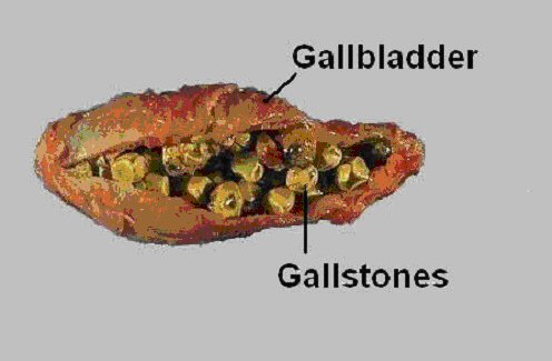 Gallbladder Stones Diet Coffee