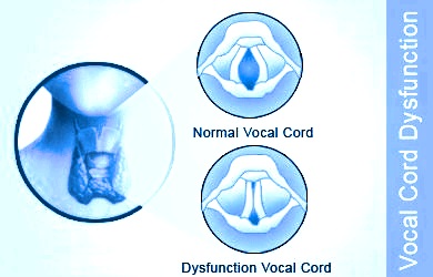 vocal nodules singers hoarseness Homeopathic treatment