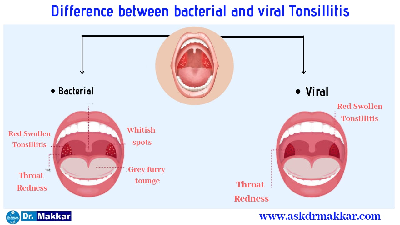 Tonsils(Tonsillitis) Online Homeopathic Treatment india ,Symptoms ...