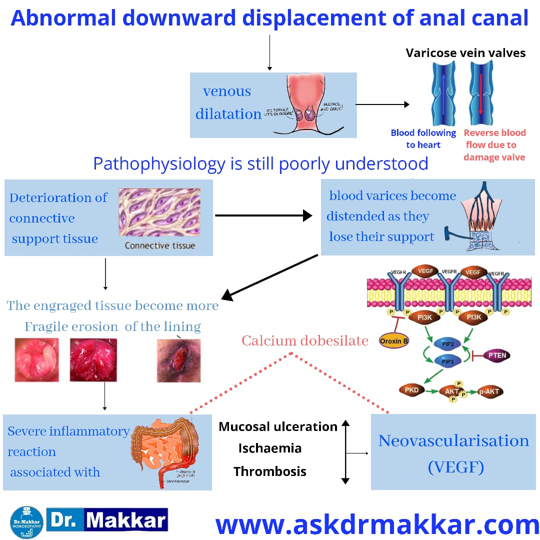 Piles || Haemorrhoidal veins || Bleeding & Non Bleeding Piles || Cause ...