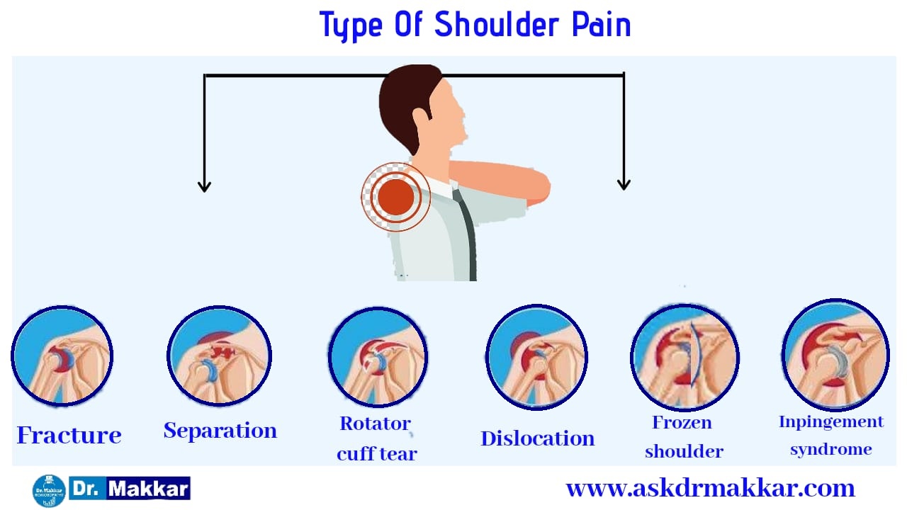 Types  of Shoulder Pain