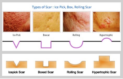 Acne scar types