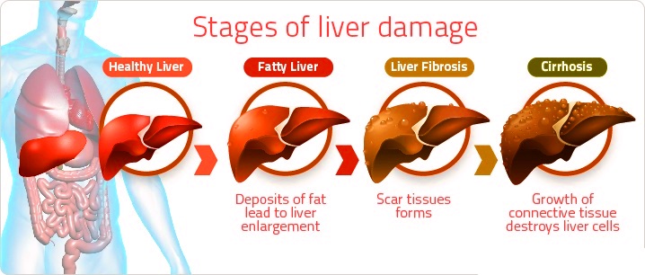 Fatty Liver Causes Symptoms and Homeopathic Treatment FLD