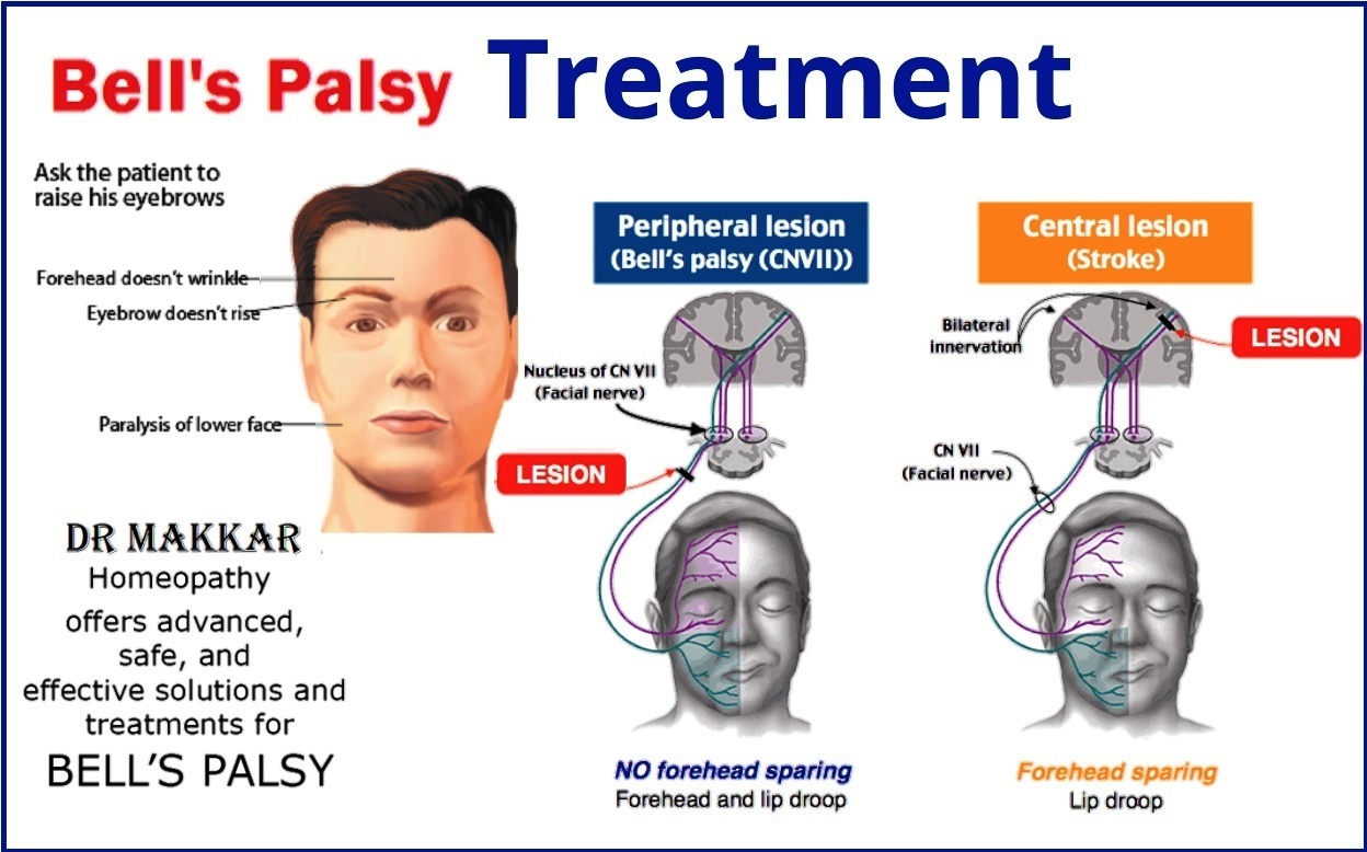 Bells Palsy Treatment Guidelines 2020 The Role Of Rehabilitation In