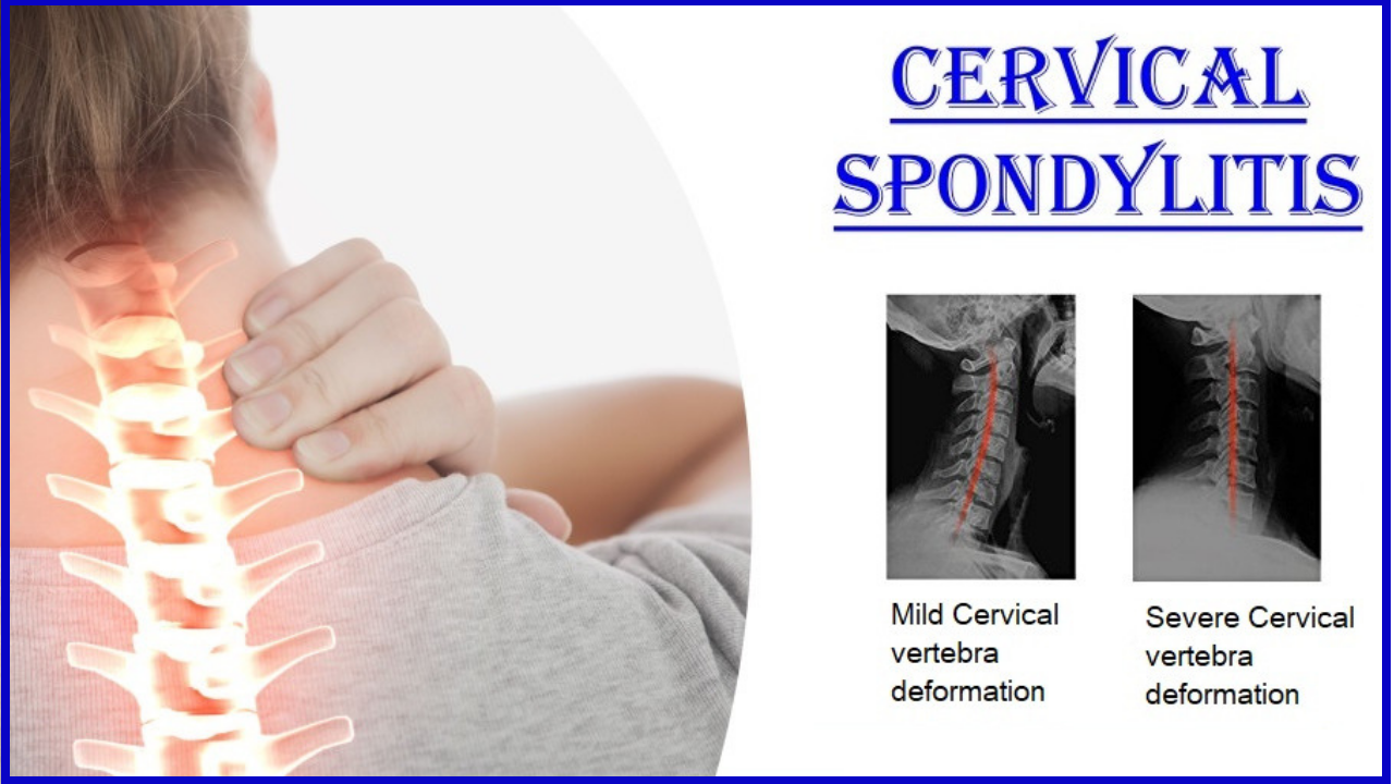 Cervical Spondylosis Neck Pain Neck Pain Leads To Giddiness Vertigo Cervical