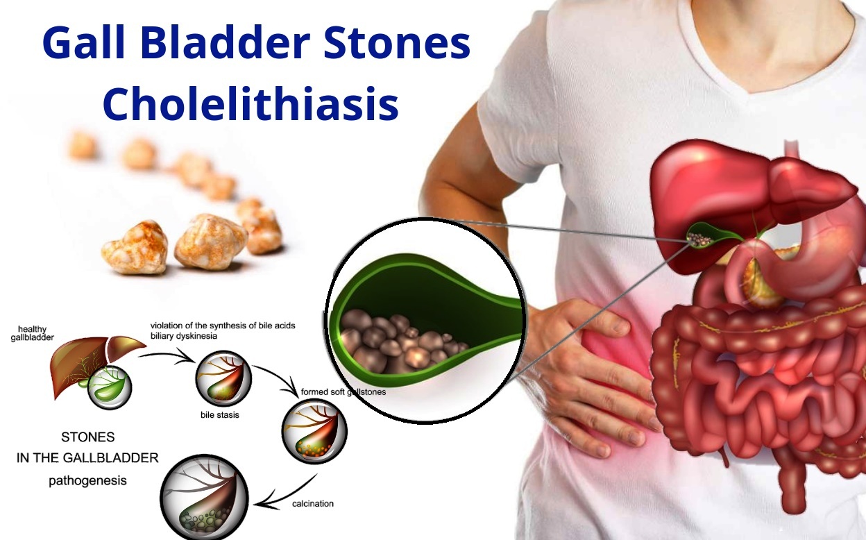 Gallstones Cholelithesis Homeopathic Treatment Gall Bladder Stone Remove Without Surgery Proven