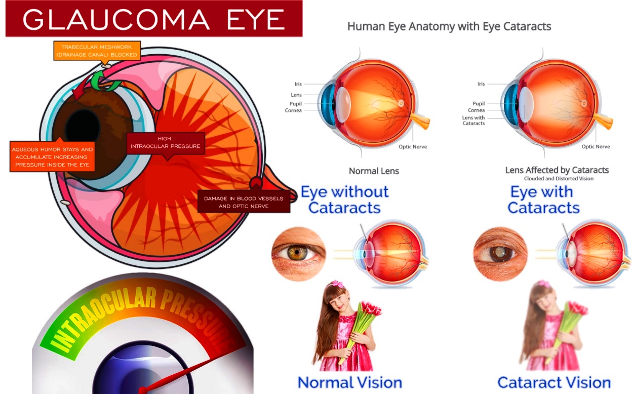 Glaucoms Intraocular Pressure IOP Homeopathic Treatement Glaucoma 