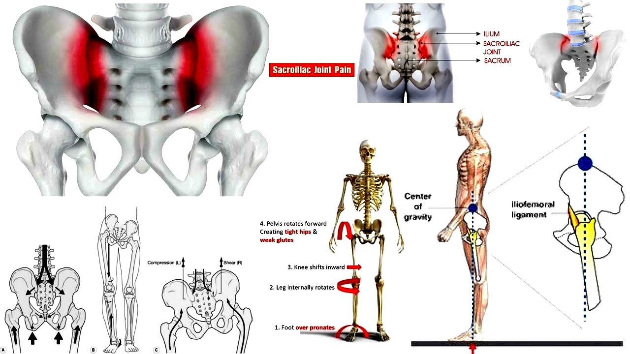 Sacroiliac Joint Dysfunction | SI Joint Pain | Sacroiliitis | SI Joint ...