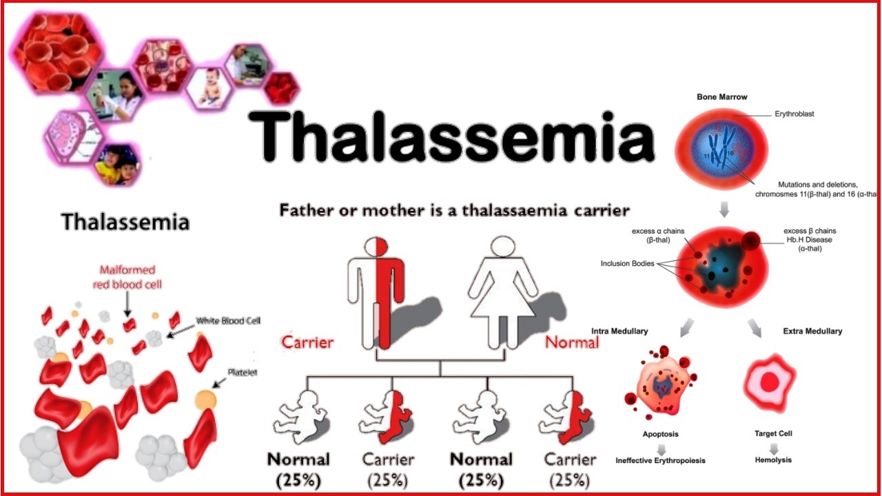 Pathophysiology Of Alpha Thalassemia