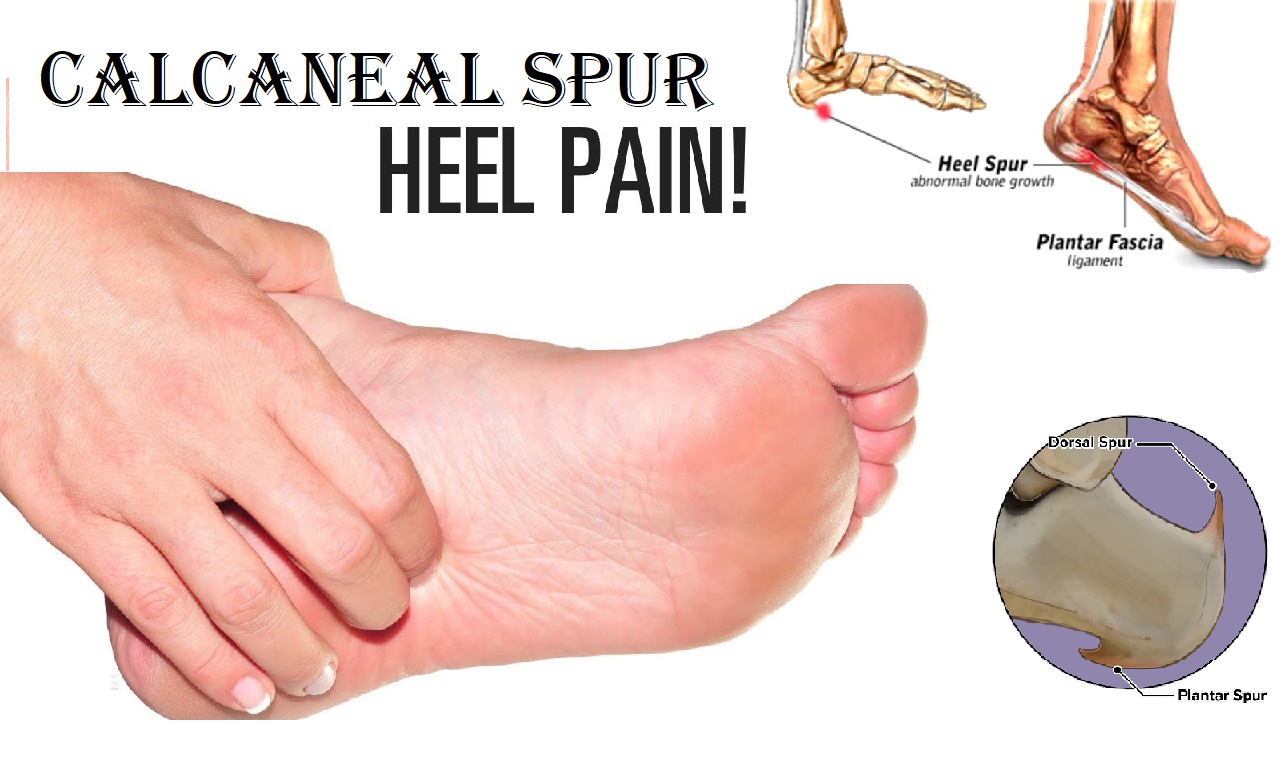 homeopathic medicine for calcaneal spur