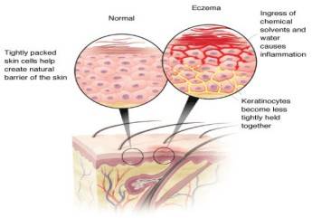 Eczema Dry Itch Homeopathic Treatment diagram of dandruff 