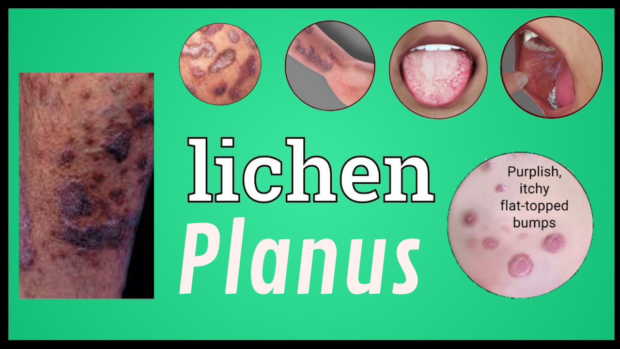 Lichen Planus Purple Patches On Skin Cutaneous Skin Autoimmune Disease Best Homeopathic Medicines Get Rid Of Lichen Planus Lesion With Homeopathy